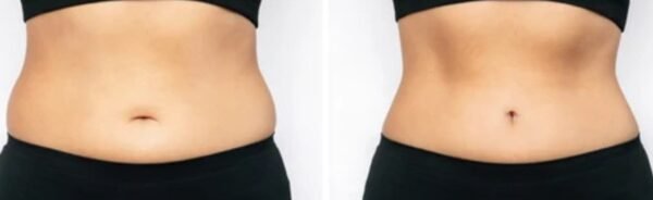 Belly Liposuction