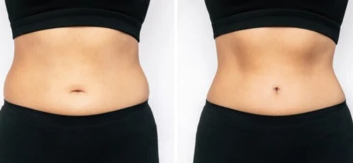 Belly Liposuction