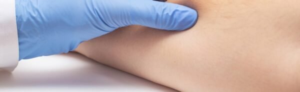 Lipoma