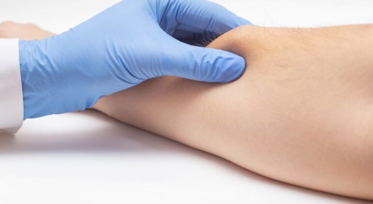 Lipoma Lipoma